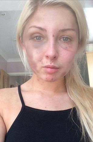 A DOMESTIC abuse victim has revealed sickening pictures of the horrific injuries she suffered at the hands of her former partner. Brave Kelsie Skillen was beaten to a pulp by her vicious boyfriend James McCourt, 19, at the home they shared together. The graphic pictures show her injuries after being subjected to a beating lasting four hours in June this year. Kelsie, 19, a make up artist from Bishopbriggs, near Glasgow, was rushed to hospital following the attack which left her with cuts to her face and covered in bruises. McCourt has been remanded in custody to await sentencing after he admitted the brutal assault during an appearance at Glasgow Sheriff Court. Kelsie said she wanted to warn other people about McCourt so that they don't suffer the same fate as her.